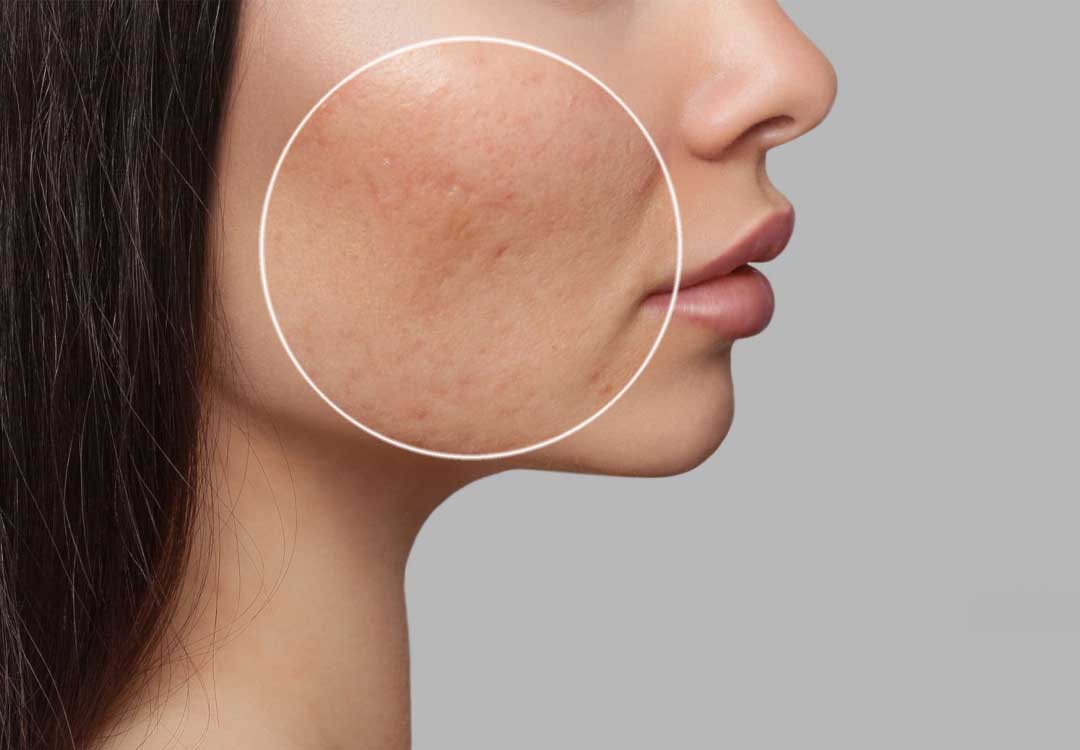 Acne Scars