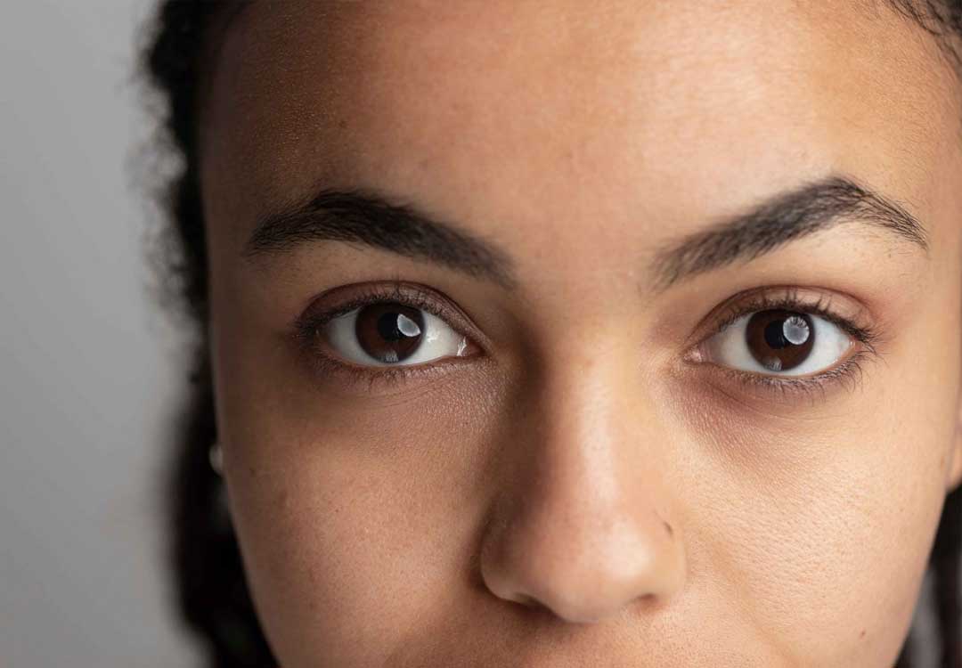 Dark Circles + Puffiness