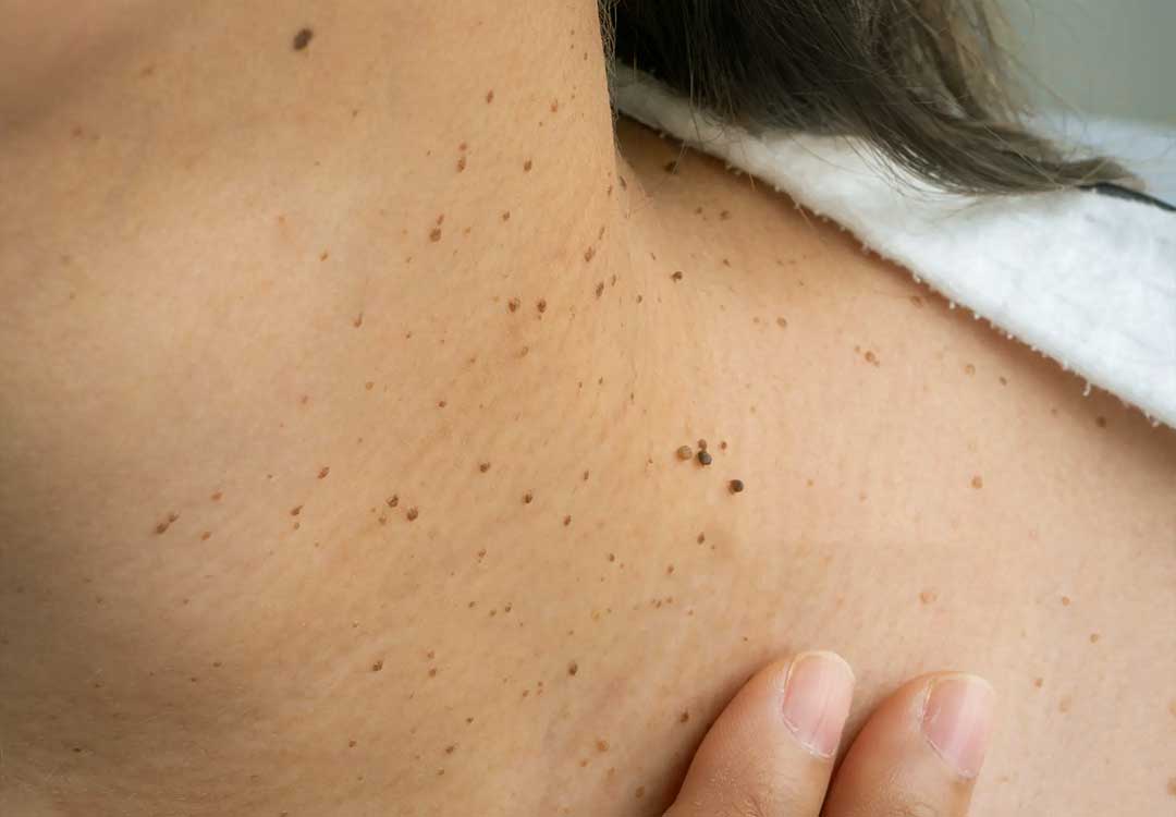Moles or Warts