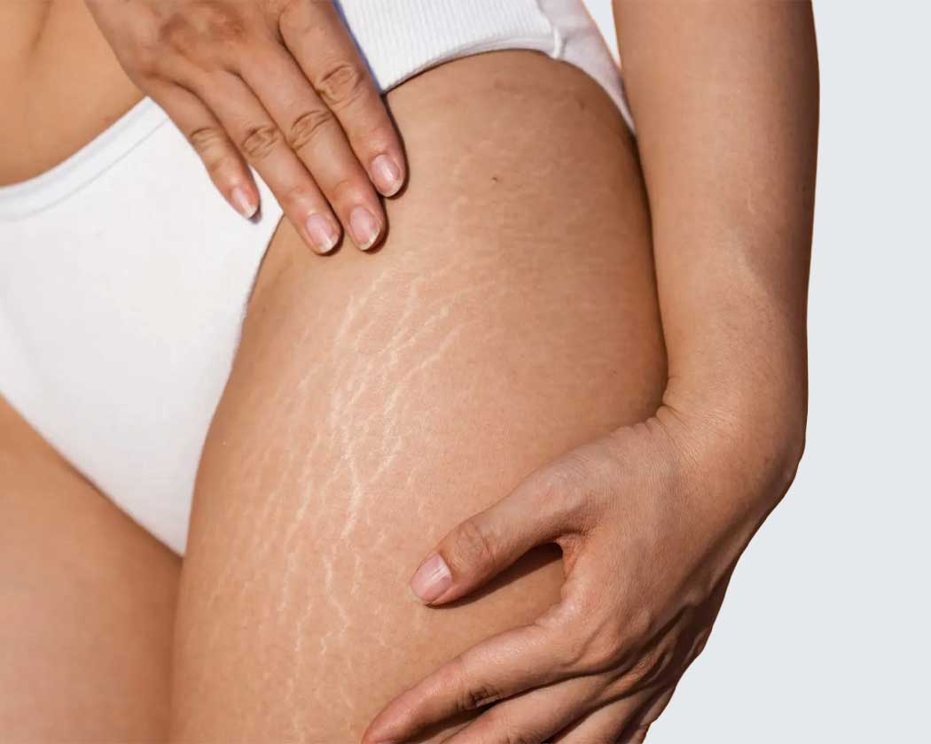 Stretch Marks